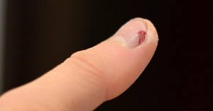 Vom Akkuschrauber verletzter Daumennagel